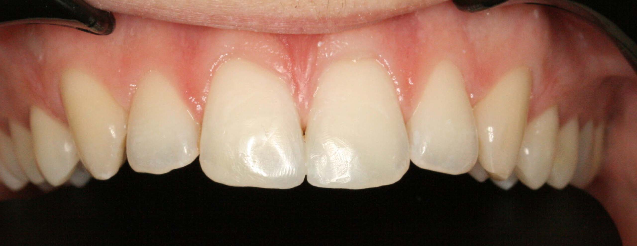 estetica dental despues